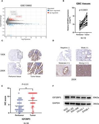 IGF2BP3 promotes progression of gallbladder carcinoma by stabilizing KLK5 mRNA in N6-methyladenosine-dependent binding